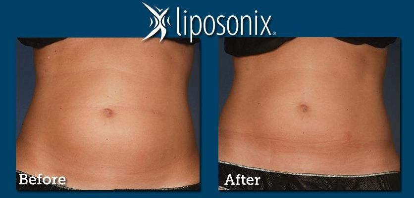 Liposonix – ультразвуковой аппарат для коррекции фигуры